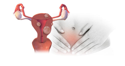 الأورام الليفية الرحمية....  رحلة التشخيص والعلاج