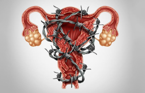 كيف يؤثر الأندومتريوز على الخصوبة؟